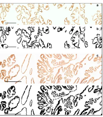 Figure 1. In (a) the image shown is a strip from a specimen of CTR group immunos-(c) the image shown is a strip from a specimen of BPH group immunostained to ck18; In (d) the binarised picture from (c) is depicted, the ck18 immunoreactive cytoplasm is in b