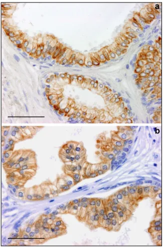 Figure 2. Sections immunostained to ck18 and counterstained with haematoxylin: In (a) image from a CTR case; in (b) an image from a BPH case