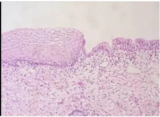 Fig 1. Squamocolumnar junction of cervix 