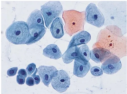 Fig 5. Normal cytology seen in pap smear 