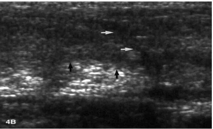Figure 6 Follow-up scan at nine months demonstrating the healed tendon with a subtle 