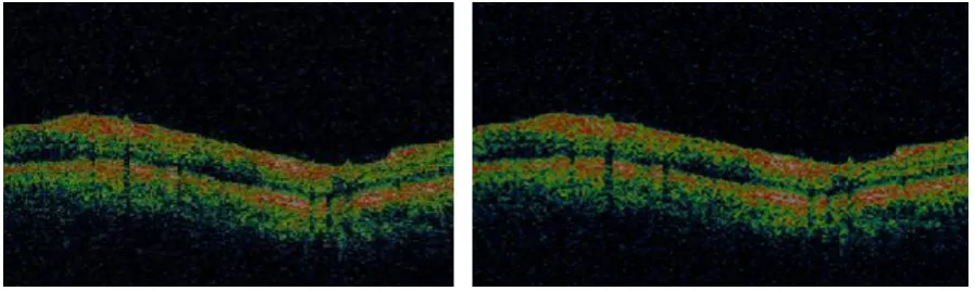 Fig 1.1. Input Image                                            Fig 1.2 Adaptive Median Filter Output 