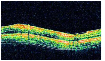 Fig 3.3 FCM Based Normalised Graph Cut Segmented Image 