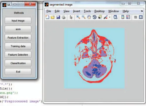 Fig.5. Result Analysis of tumor detection 