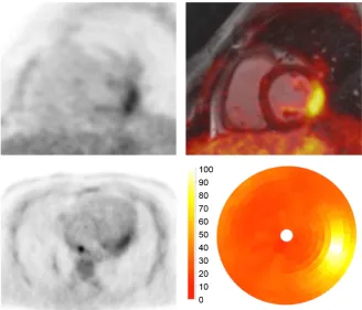 Figure 7. FDG PET/MR images in a patient with cardiac sarcoidosis. PET images (top left, bottom left) as well as fused PET/MRI (top right) demonstrate focal FDG uptake in the inferolateral left ventricular wall