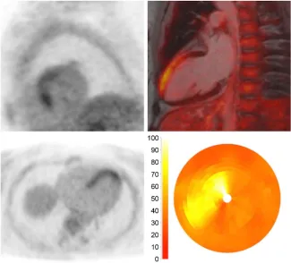 Figure 8. FDG PET/MR images in another patient with myocarditis. PET images (top left, bottom left) as well as fused PET/MRI (top right) demonstrate inhomogeneous FDG uptake in the septum and the anterior wall
