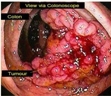 Figure 3: Different layers of the normal human colon. (Source: www.penncancer.org) 