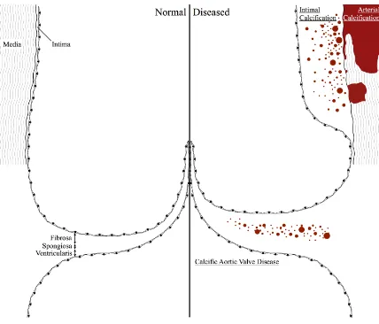 Figure 1.1: The sinus of valsalva and three types of cardiovascular calcification. 