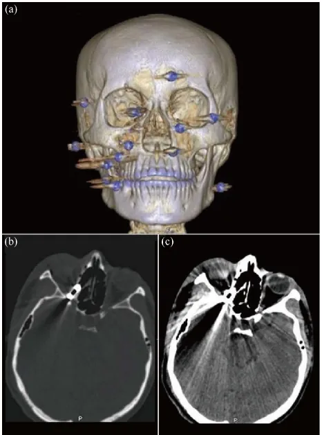 Figure 1. Patient injured by gunshot who developed blindness only. Initial clinical aspect (A); 3-dimension computerized tomography reconstruction (3-DCTR) with presence of foreign body in orbit (B); Axial cuts on computerized tomography (CT) after blunt t