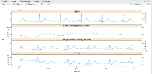 Figure 3. Abnormal ECG Signal Data preprocessing 