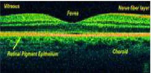 Fig. 1 shows an OCT scan of retina.  OCT can be particularly helpful in diagnosing: 