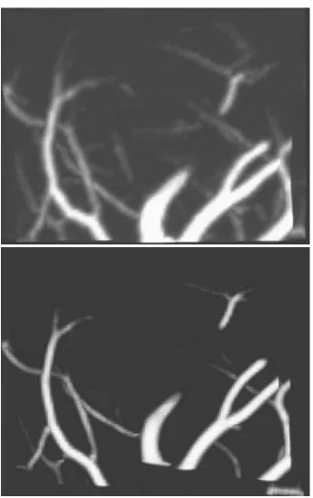 Figure 1.3: The ﬁrst image is the original intensity image, the second image is the thresholdedvesselness measures.