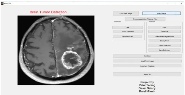 Figure 3 MATLAB GUI of Brain Tumor Detection  