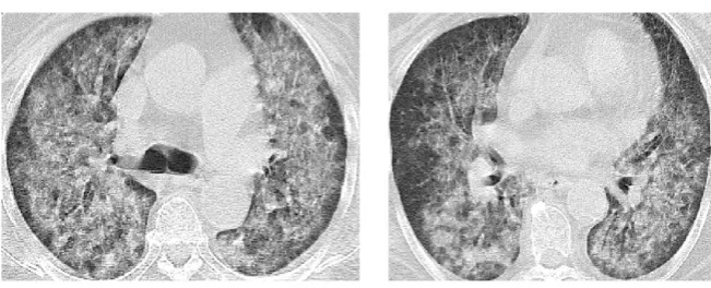 Figure 1. Chest CT on admission (Case 6). 
