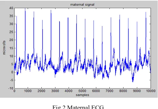 Fig 2.Maternal ECG 