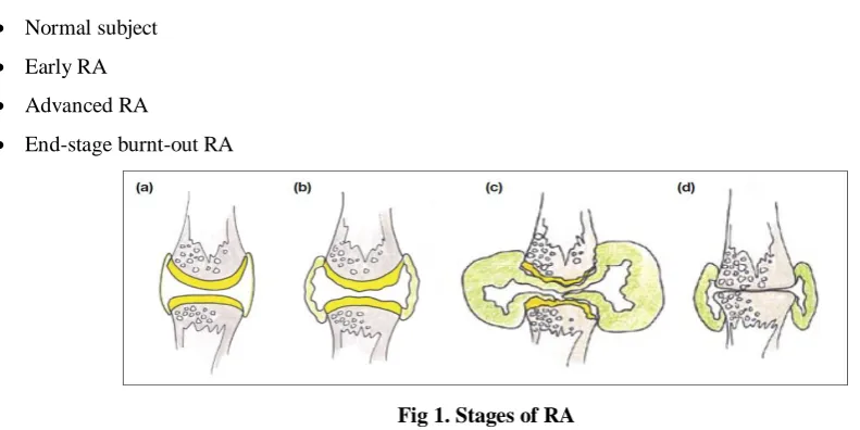 Fig 1. Stages of RA 