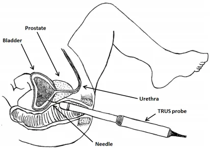 Figure 2-1: Biopsy procedure schematic with TRUS probe inserted into the 