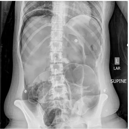 Figure 1. Massive iatrogenic pneumoperitoneum and dilated bowel in the left abdomen in the region of the prior surgical anastomosis post endoscopy