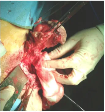 Figure 1. Vulvar tumor resection. 