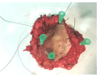 Figure 2. Vulva after tumor resection. 