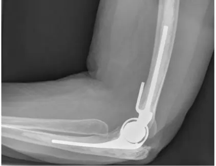 Figure 1.4: X-ray of a total elbow arthroplasty. ‎