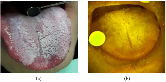 Figure 1. S.I. Female age 52 squamous cell carcinoma on the floor of the mouth: (a) Opt-ical photo—increasing progression of tumor during 1 year from detection