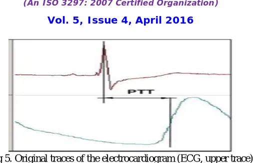 Fig 5. Original traces of the electrocardiogram (ECG, upper trace)  Showing the detection of R-wave and pulse wave in calculation of the pulse transition time (PTT) 