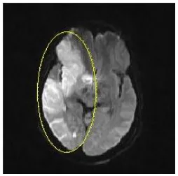 Fig. 1: A sample Diffusion Weighted Image (DWI)  