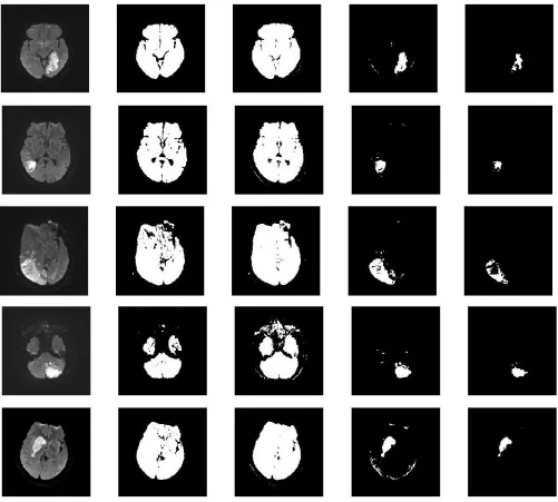 Figure. 2 Results obtained:(a)Original Image (b) Otsu’s threshold (c) Mean threshold (d) Histogram based threshold (e) Proposed threshold 