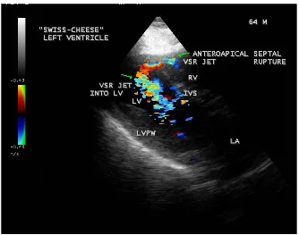 Figure 13. Parasternal long axis view showing the anteroapical ventricular septal rupture