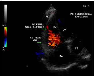 Figure 2. Color doppler imaging showing the RV free wall rupture into the pericardial space with effusion in a 66-year-old female with acute inferior wall infarction