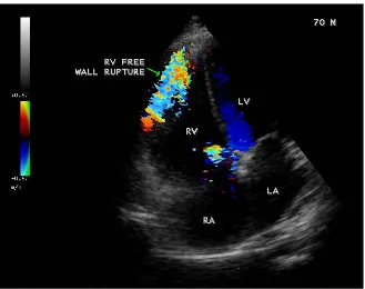 Figure 4. 2D echocardiographic imaging showing the large RV free wall rupture in a 70-year-old male with right ventricular infarction in apical four chamber view