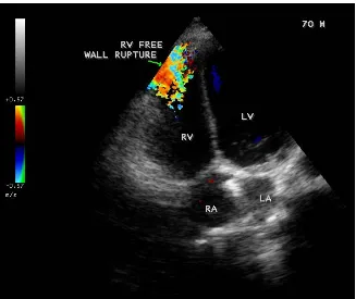 Figure 6. Color doppler imaging showing the RV free wall rupture with a dense doppler signal in a 70-year-old male with right ventricular infarction