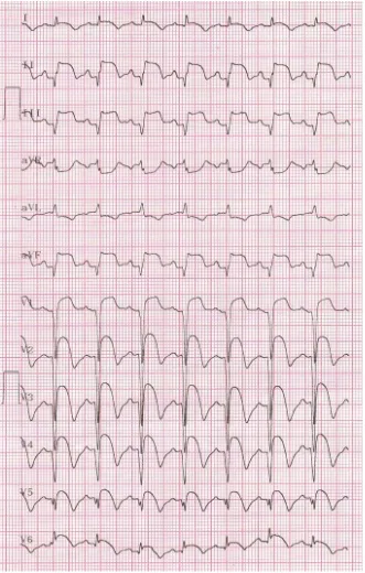 Figure 7. ECG (2 days after thrombolysis) showing persistent ST segment elevation in anterior and inferior leads (wraparound LAD (left anterior descending coronary artery)) occlusion