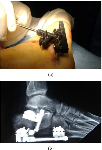 Figure 1. (a), (b) External mini-fixator for the minimally invasive reduction and fixation of the calcaneal fractures