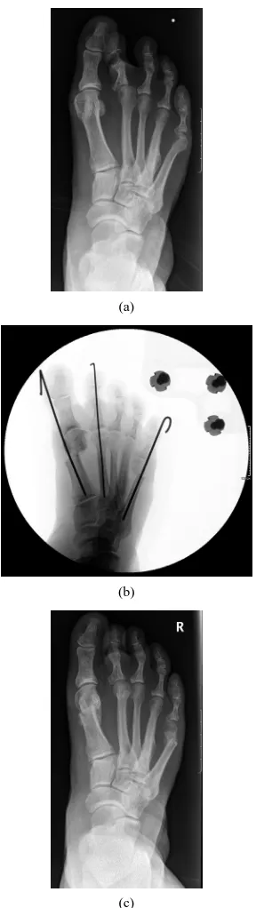 Figure 4. (a) Patient of 58 years old with hallux valgus, bunionette and varus deformity of the fifth toe