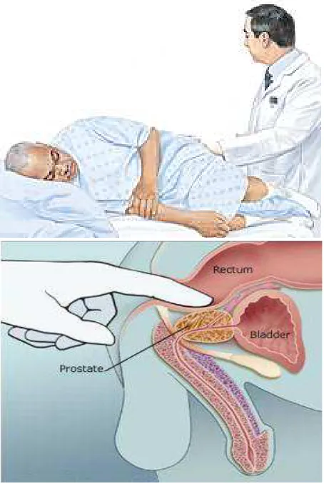 Figure 1.12: Top) Patient position during DRE. Bottom) Digital rectal examination.