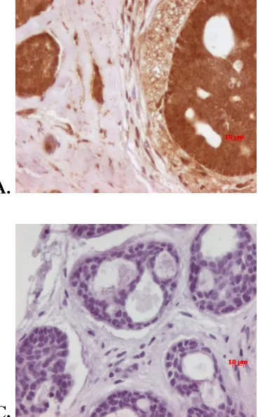 Figure 4-10 IHC staining of ACC for OPN, CD44, and integrin αvβ3 at 400x original 