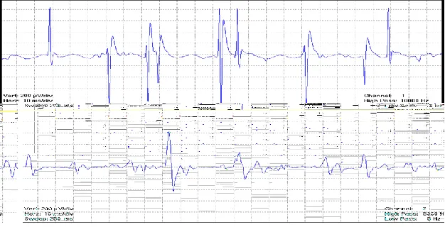 Figure 1.2 Spike-triggered averaging.  An example of the simultaneous collection of an intramuscular EMG signal (top panel) and surface EMG signal (bottom panel) from a voluntary contraction, as occurs in STA and DE-STA MUNE techniques (A)
