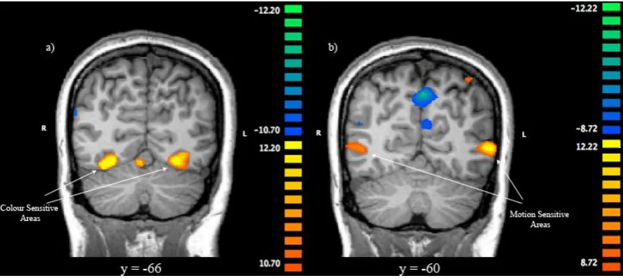 Figure 4. Four ROIs within category-specific extrastriate areas in an example subject
