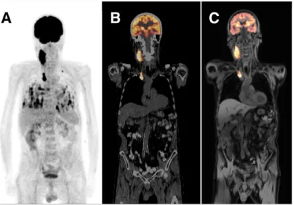 Figure 1.1: (A) Whole-body PET scan displayed as a maximum intensity projection,(B) PET/CT overlay (PET is in orange), and (C) PET/MRI overlay (PET is inorange)