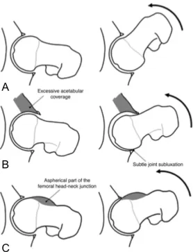 Figure 2.2 - FAI pathology during flexion in a coronal view of the hip. (A) Normal hip joint clearance and movement during flexion