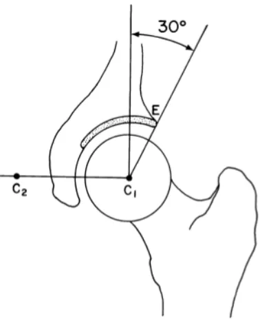 Figure 2.3 - Centre-edge (CE) angle, as described by Wiberg [19], is measured on a centre cut coronal MRI