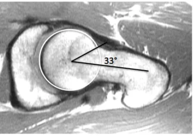 Figure 2.5 - Alpha angle. A normal alpha angle measurement on an MR image of a 25-year-old male