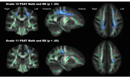 Figure 6: White matter structures showing a negative correlation with RD and PSAT math scores in Grade 10 and Grade 11