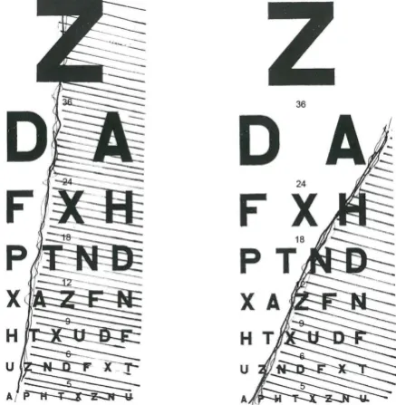 Figure 1. Right eye visual acuity testing showing absolute temporal blocking (left) and graded blocking (right)