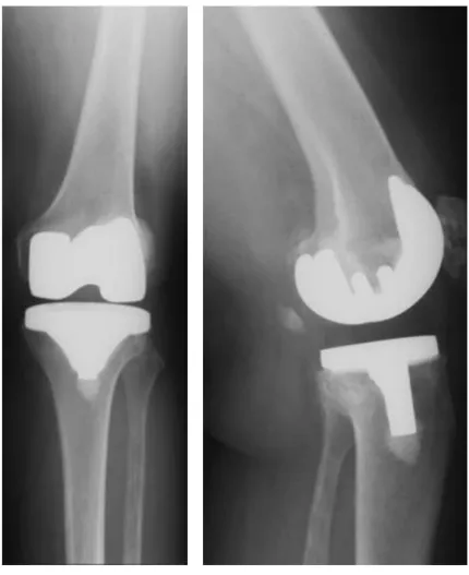 Figure 1.9 – X ray of PCL retaining prosthesis. This is x ray image of the 