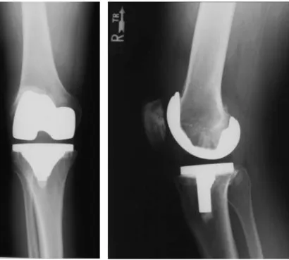 Figure 1.10 – X ray of PCL sacrificing prosthesis. This is an anteroposterior (A) and 