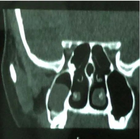 Figure 4. Pneumatised uncinate process. 