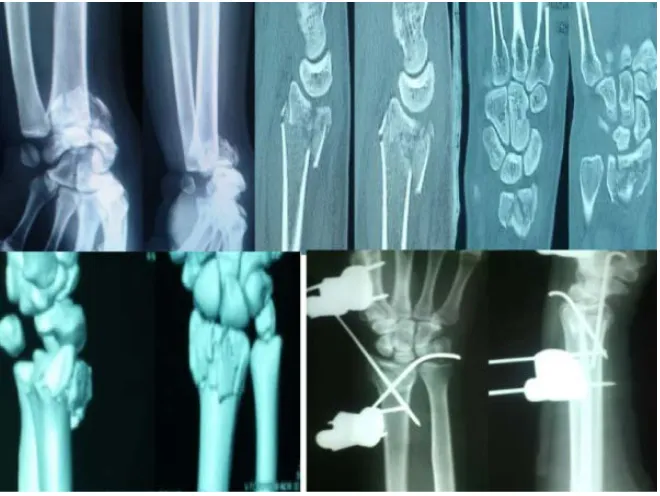 Figure 1. Intra-articular comminuted fracture distal radius treated by external fixator augmented by K-wire